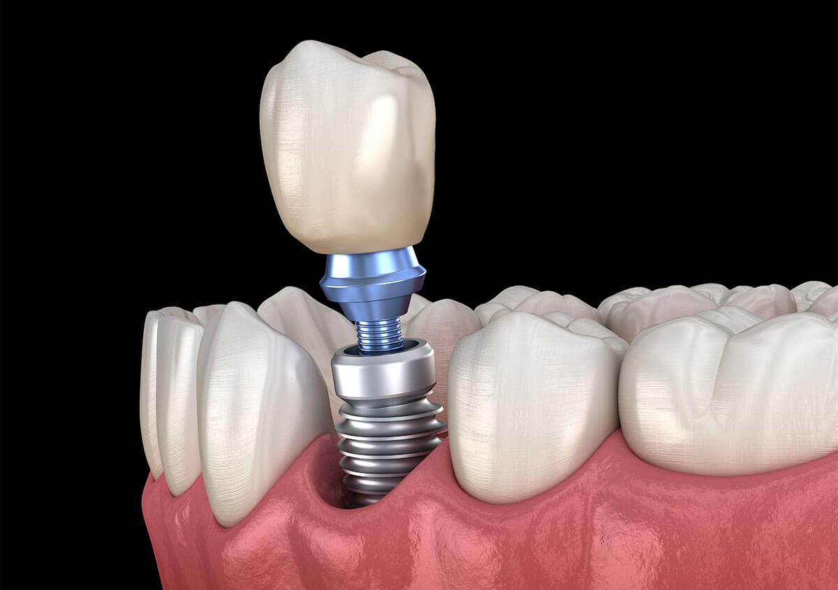 Dental Implant Placement in Tysons VA Area